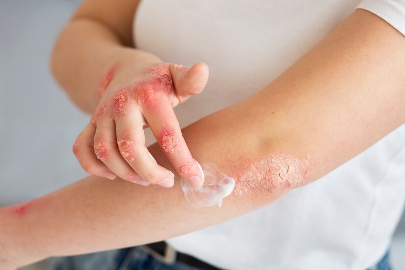 Understanding Psoriasis: A Guide to Managing Your Skin Condition